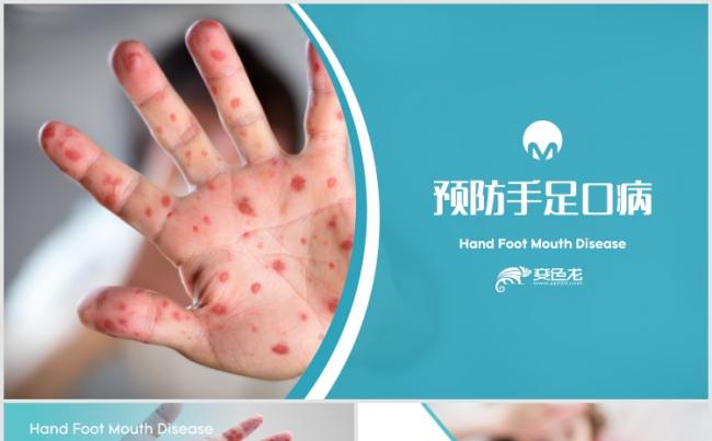 儿童手足口传染疾病的预防与治疗PPT模版缩略图